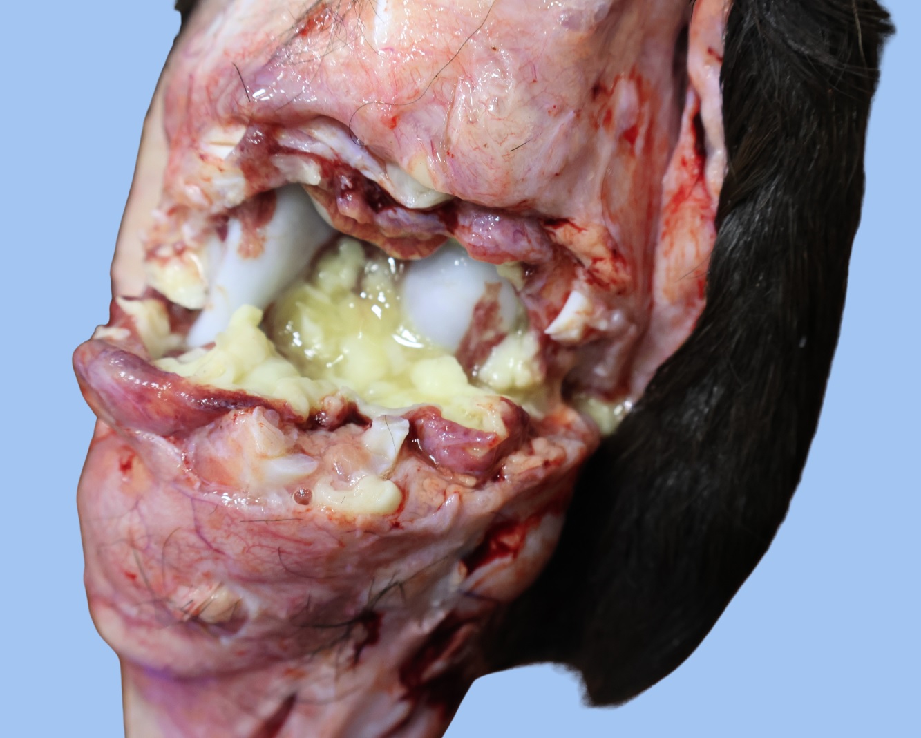 Bovine Umbilical Vein