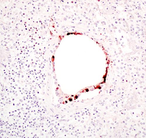 Pig - bronchiolar epith necrosis and Influenza A antigen